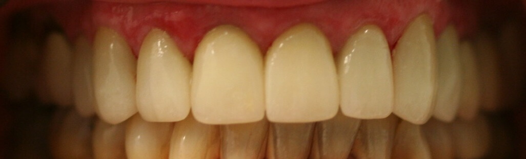 Crowns & Veneers After