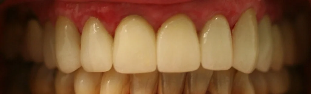 Crowns & Veneers After