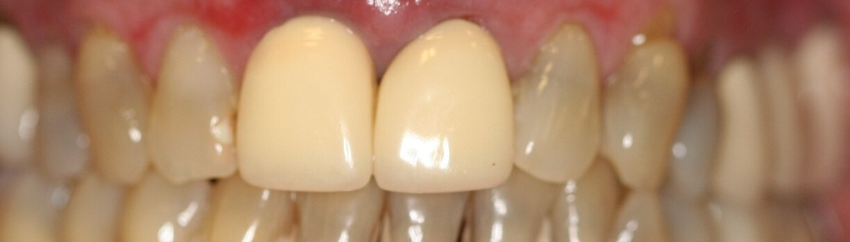 Crowns & Veneers Before