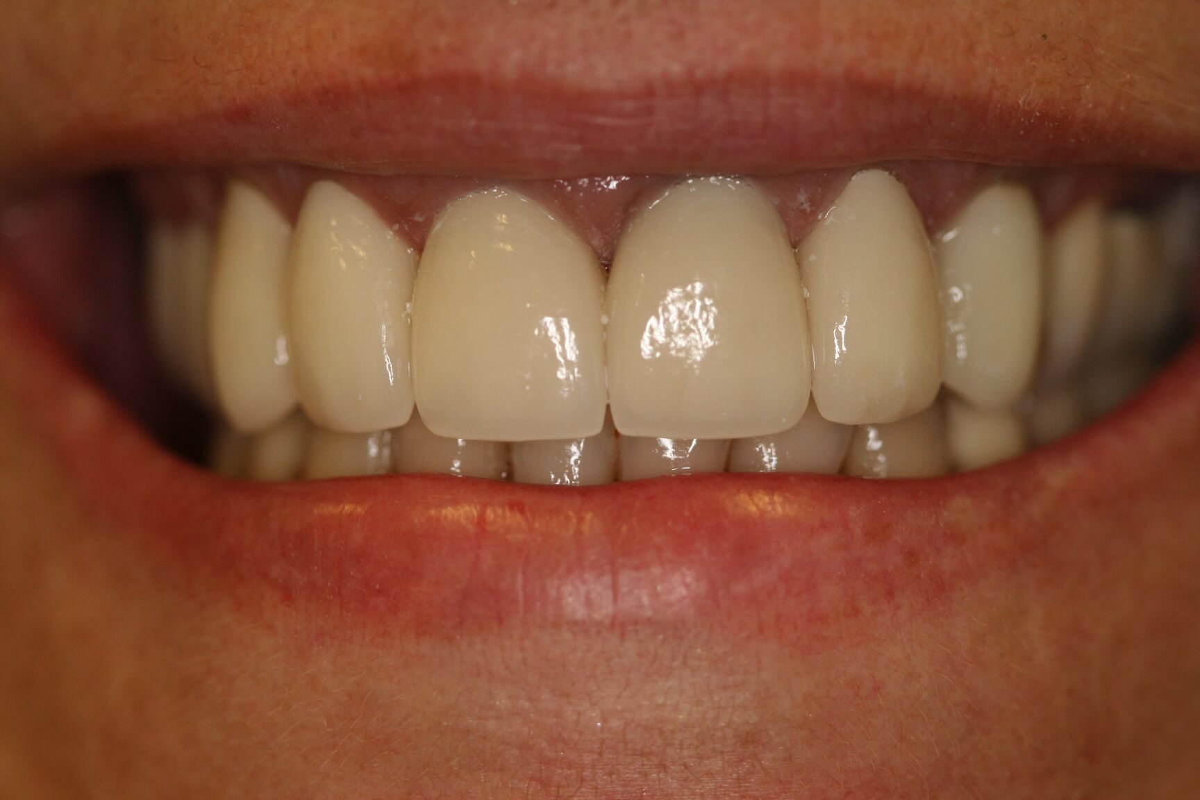 Crowns After