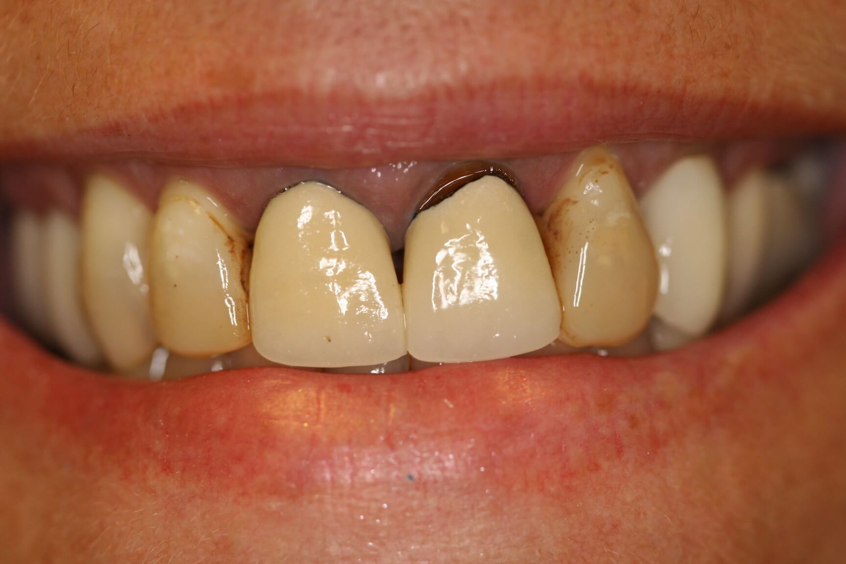 Crowns Before