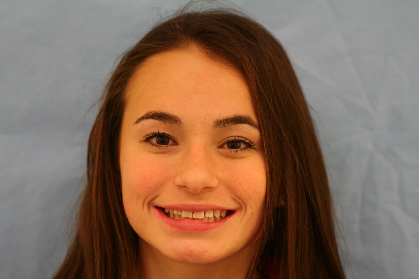 Invisalign Before